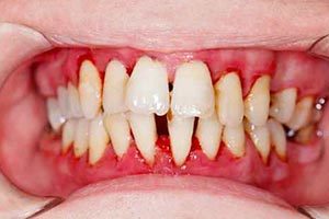 Periodontal (Gum) Therapy