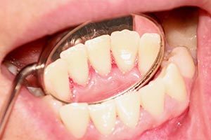 Periodontal (Gum) Therapy